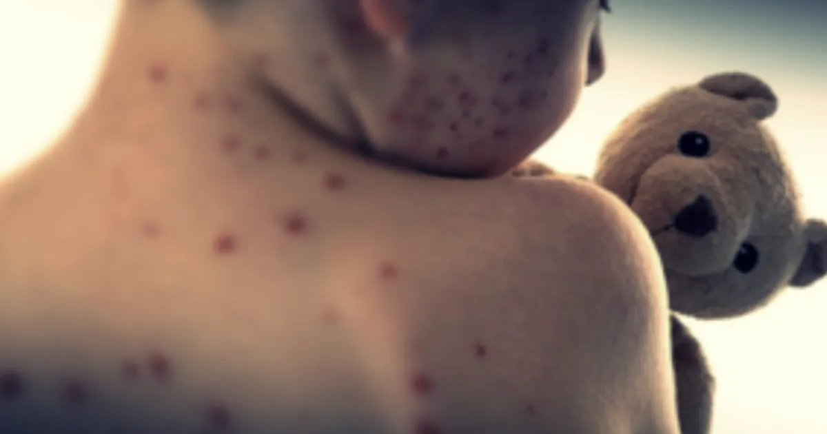 Measles Outbreak in Texas! 560 Cases Sparks National Concern
