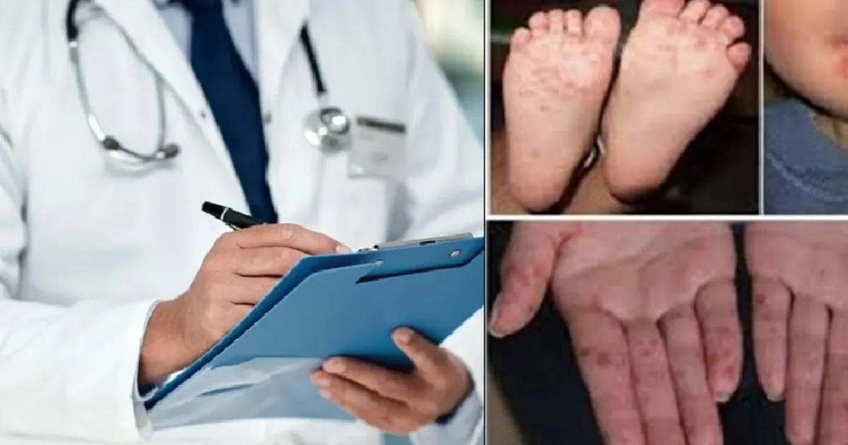 Monsoon Triggers Surge in Delhi’s Hand Foot Mouth and Flu Cases
