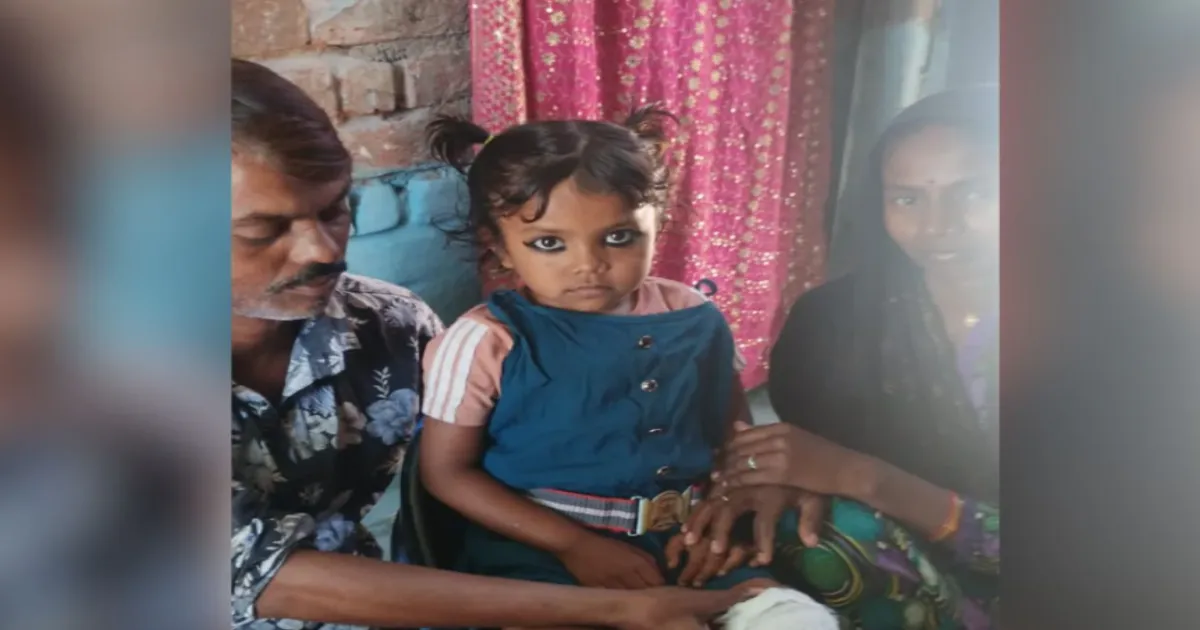 Her Leg Had to Be Amputated': Family Alleges Six-Day Delay By UP Doctor Led to Five-Year-Old's Disability