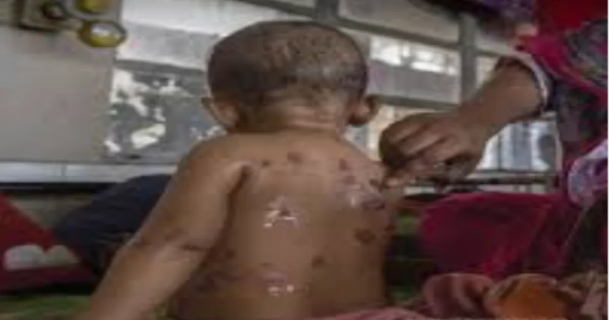  Bangladesh Measles Death Toll Rises to 585 Since March 15 as Over 70,000 Cases Reported