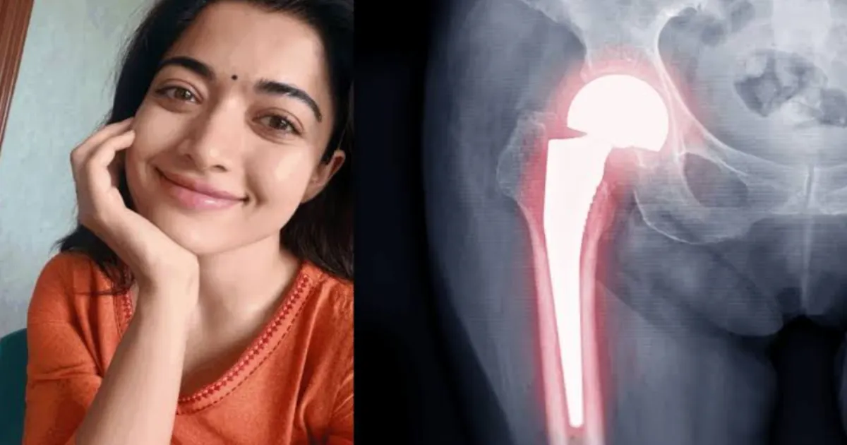 Rashmika Mandanna Shares Details of Her Hip Injury Recovery Routine
