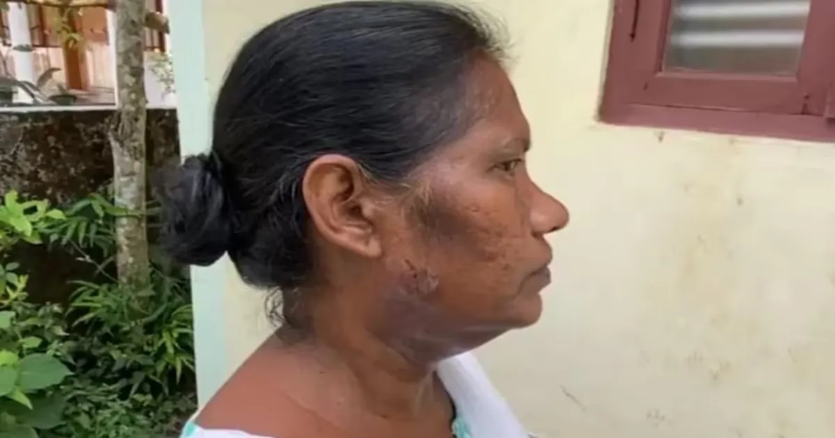 kerala-election-officer-mauled-by-pet-dog-during-voter