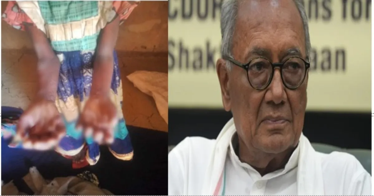 Contaminated Water Behind Betul Skin Disease, Digvijaya Singh Confirms