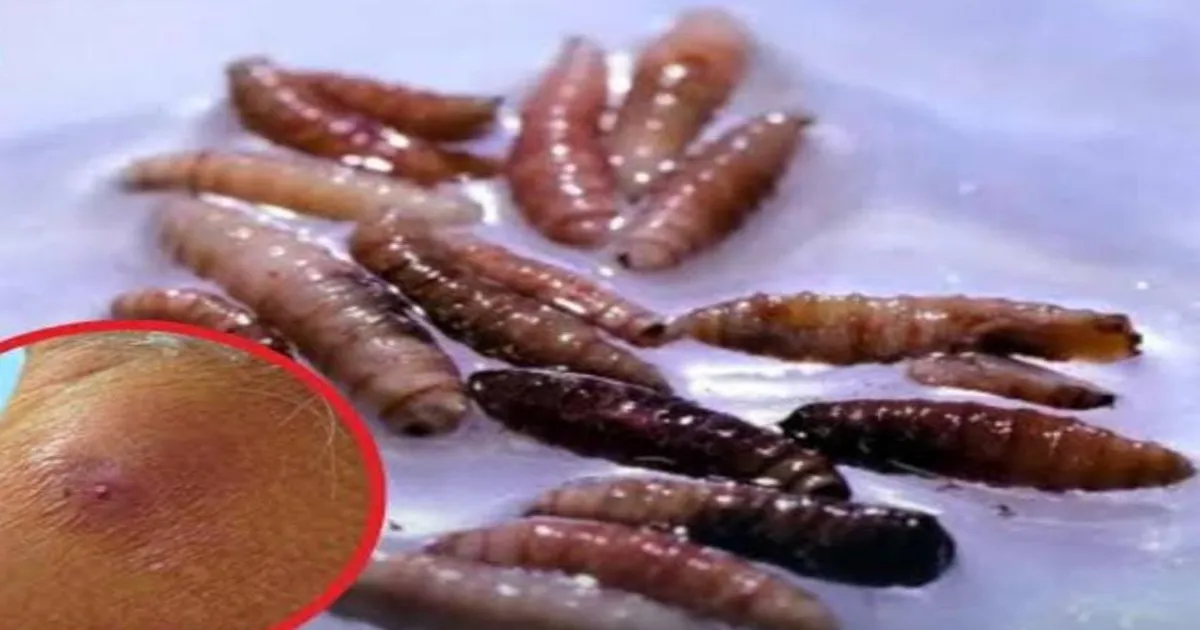 Texas Reports Confirmed Case Of Flesh-Eating New World Screwworm