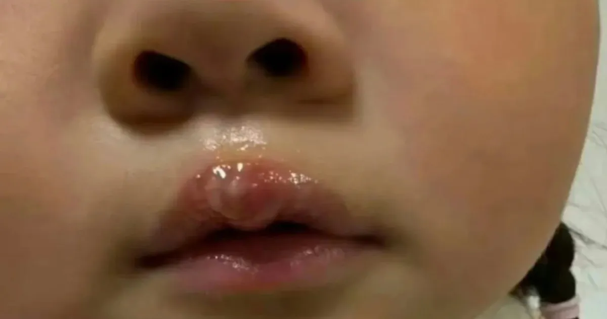 Teacher Suspended After 4-Year-Old Suffers Burns in Jiangsu Kindergarten