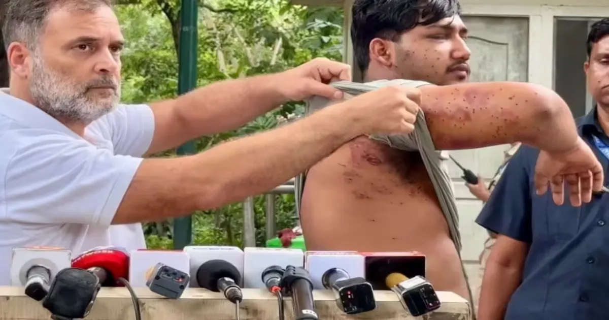 Rahul Gandhi Raises Kashmir Concerns Alongside Pellet Injury Victim