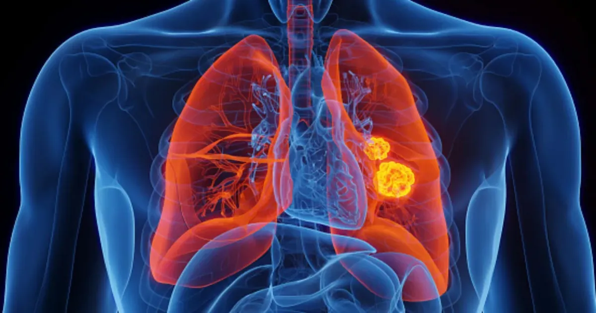 Lung Cancer Diagnosis: Leading Oncologist Shares Steps After Patients Learn The Truth