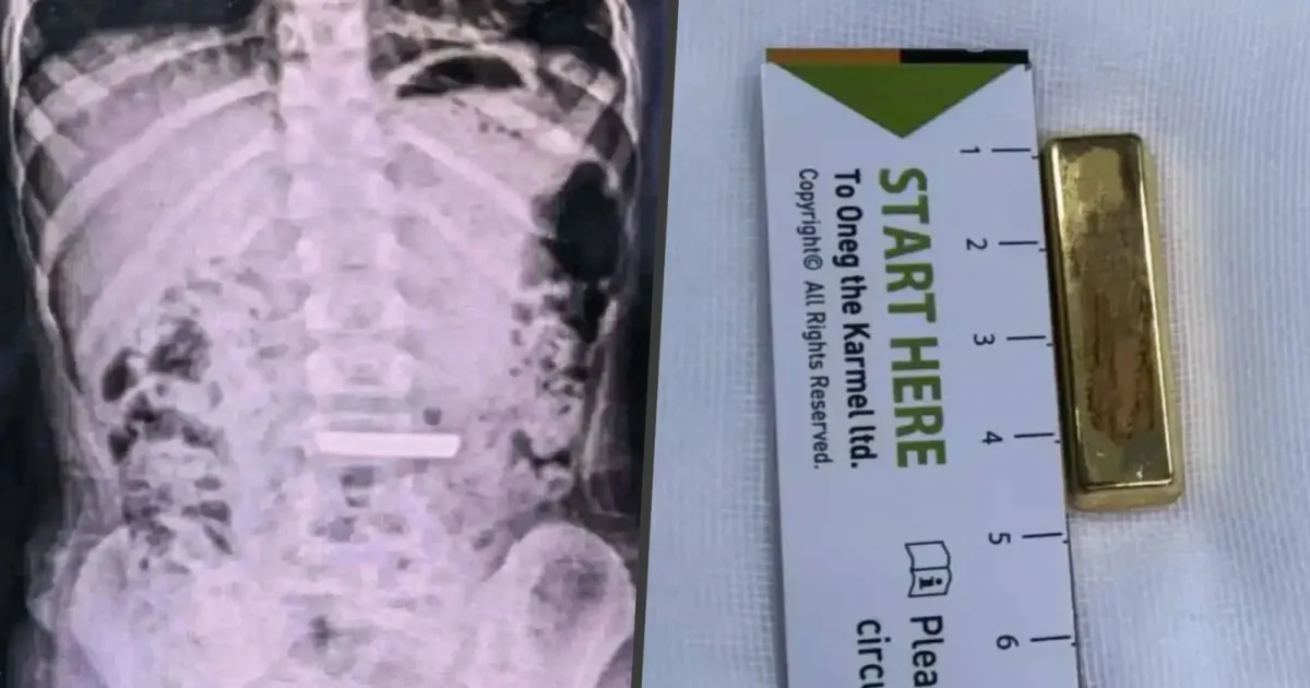 5-Year-Old Chinese Girl Hospitalised After Accidentally Swallowing 50-Gram Gold Bar